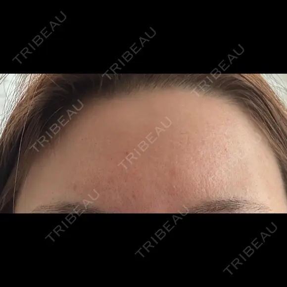 マイクロボトックス BAO CLINIC 心斎橋院 AFTER メイン用