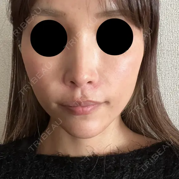 ヒアルロン酸注入（頬） ルラ美容クリニック 仙台院 / ルラスキンクリニック 仙台院 AFTER メイン用