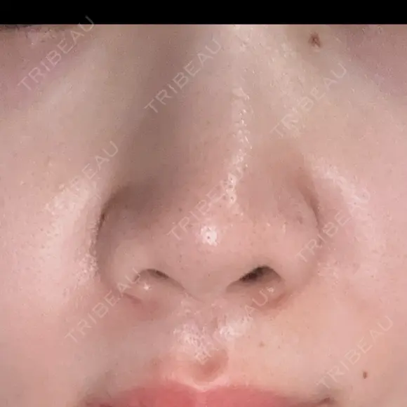 小鼻縮小（非切開） 形成外科と美容外科のクリニック池袋 DAY 1 メイン用