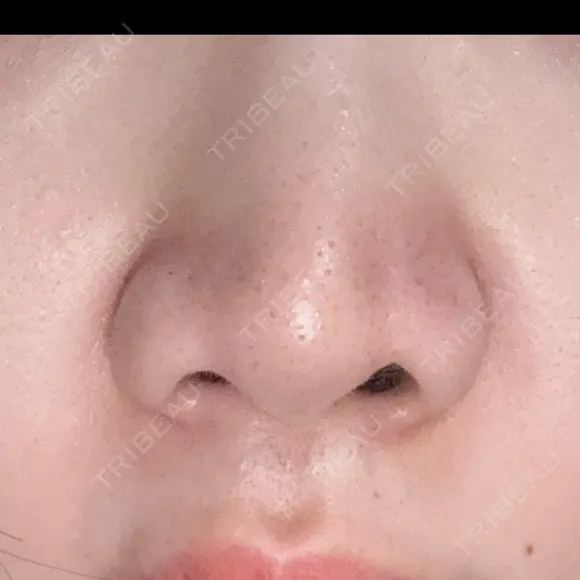 小鼻縮小（非切開） 形成外科と美容外科のクリニック池袋 DAY 2 メイン用