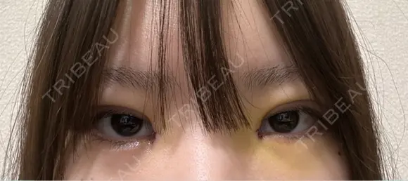 二重埋没 / 目頭切開 / 上まぶたの脂肪取り 9BeautyClinic DAY 5 メイン用