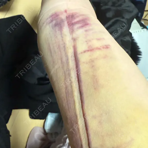 脂肪吸引（顔） / 脂肪吸引（二の腕） / 脂肪吸引（脚） / 脂肪吸引（お腹） / 脂肪吸引（お尻） / 脂肪吸引（腰） / 脂肪吸引（背中） / 脂肪吸引（肩） ヴェルトラクリニック 新宿院 DAY 3 メイン用