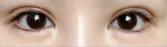 二重切開 / 眼瞼下垂（切開） ユア美容クリニック 福岡院 DAY 39 メイン用