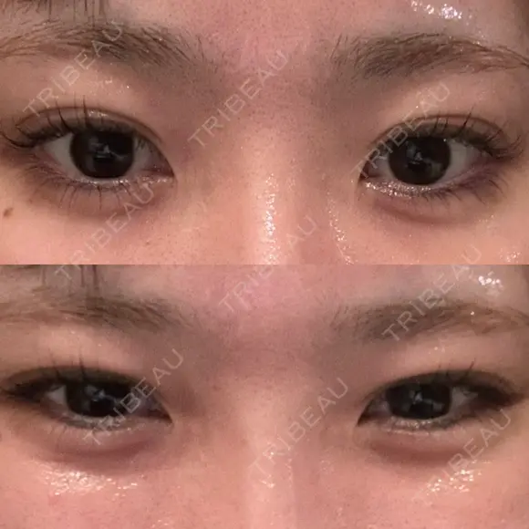 ヒアルロン酸注入（涙袋） / ボトックス（エラ・小顔） フィラークリニック 大阪心斎橋院 DAY 0 メイン用