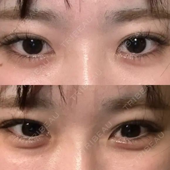 ヒアルロン酸注入（涙袋） / ボトックス（エラ・小顔） フィラークリニック 大阪心斎橋院 AFTER メイン用