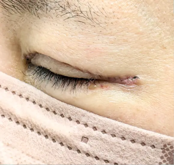 眼瞼下垂（切開） 博多もへじのクリニック DAY 6 メイン用