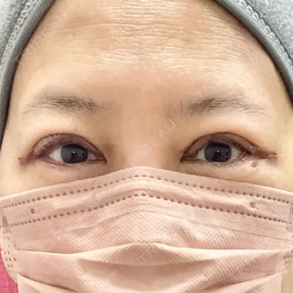 眼瞼下垂（切開） 博多もへじのクリニック DAY 6 メイン用