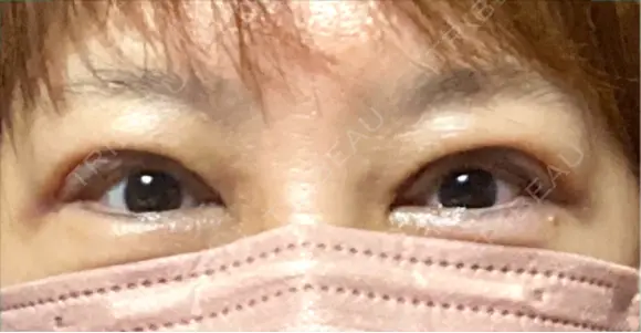 眼瞼下垂（切開） 博多もへじのクリニック DAY 7 メイン用