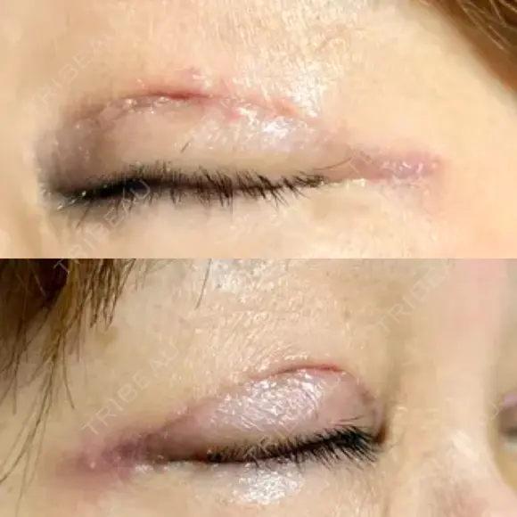 眼瞼下垂（切開） 博多もへじのクリニック DAY 7 メイン用