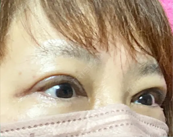 眼瞼下垂（切開） 博多もへじのクリニック DAY 14 メイン用