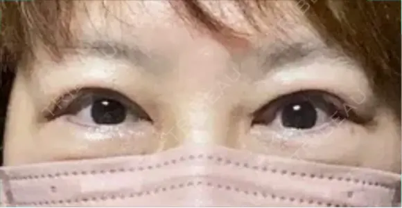 眼瞼下垂（切開） 博多もへじのクリニック DAY 14 メイン用