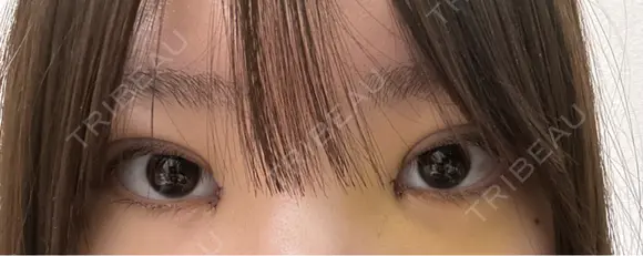 二重埋没 / 目頭切開 / 上まぶたの脂肪取り 9BeautyClinic DAY 7 メイン用