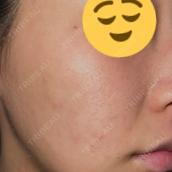 ニードルRF（ポテンツァなど） / ポテンツァ BAO CLINIC 神戸院 DAY 2 メイン用