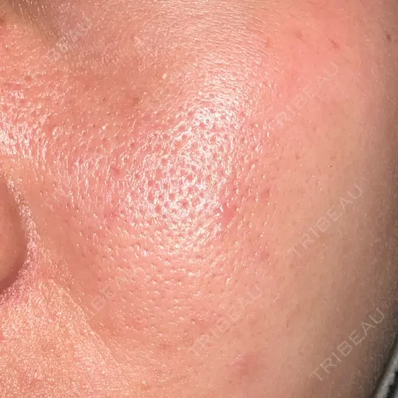 ニードルRF（ポテンツァなど） / ポテンツァ BAO CLINIC 神戸院 AFTER メイン用