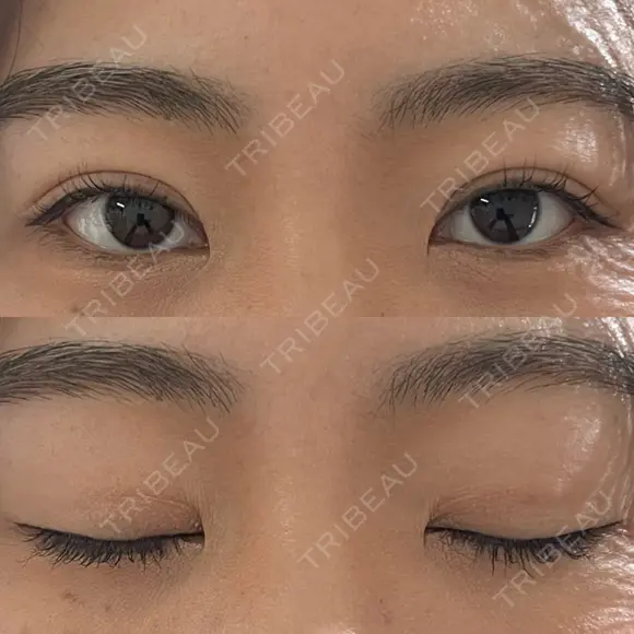 二重埋没 WOM CLINIC GINZA （ワム クリニック ギンザ） DAY 16 メイン用