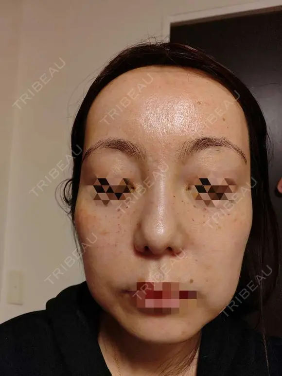 水光注射（ハリ・美肌） / 肌育注射（ジュベルックなど） Chloe Cheongdam Clinic （クロエチョンダムクリニック） DAY 1 メイン用