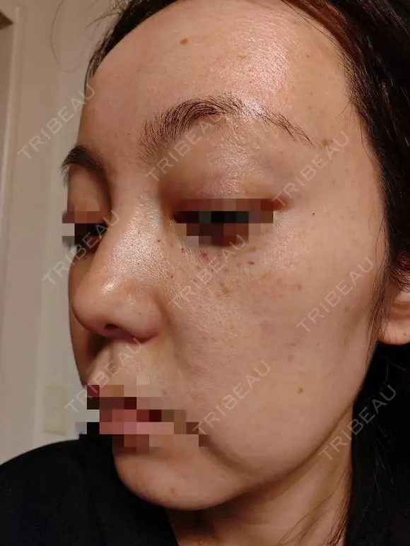 水光注射（ハリ・美肌） / 肌育注射（ジュベルックなど） Chloe Cheongdam Clinic （クロエチョンダムクリニック） DAY 1 メイン用