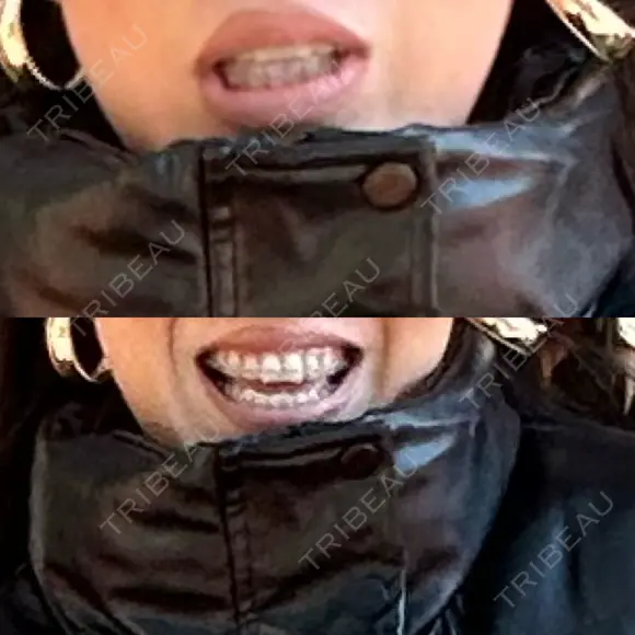 矯正（ワイヤー） Shiny Teeth Clinic 【シャイニー ティース クリニック】 AFTER メイン用