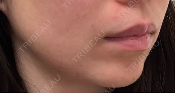 その他（輪郭） ライブリークリニック 浜松町院 DAY 0 メイン用