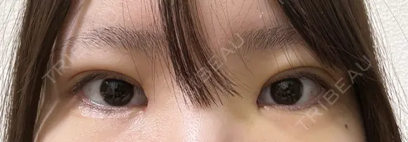 二重埋没 / 目頭切開 / 上まぶたの脂肪取り 9BeautyClinic DAY 9 メイン用