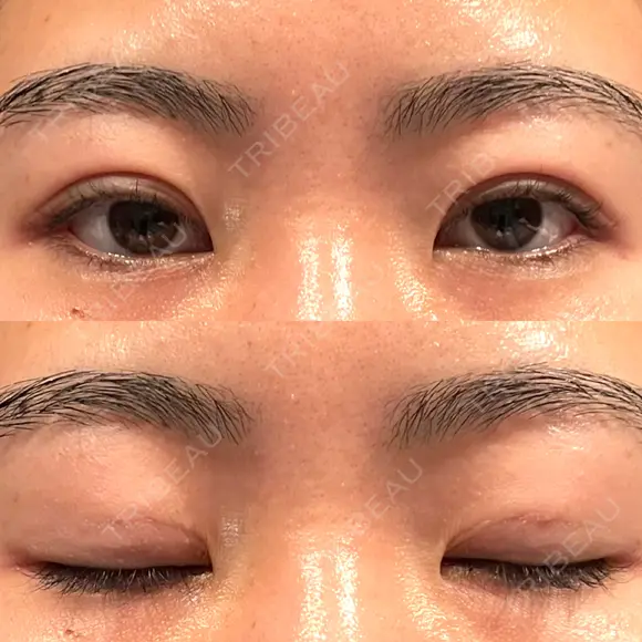 二重埋没 WOM CLINIC GINZA （ワム クリニック ギンザ） DAY 17 メイン用