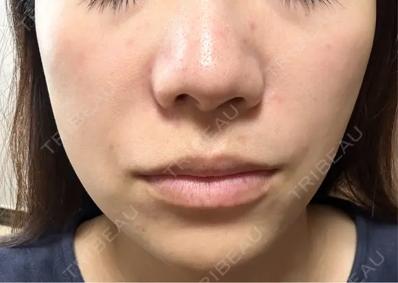 ヒアルロン酸注入（鼻翼基部） KIMI CLINIC 形成・美容外科 DAY 0 メイン用