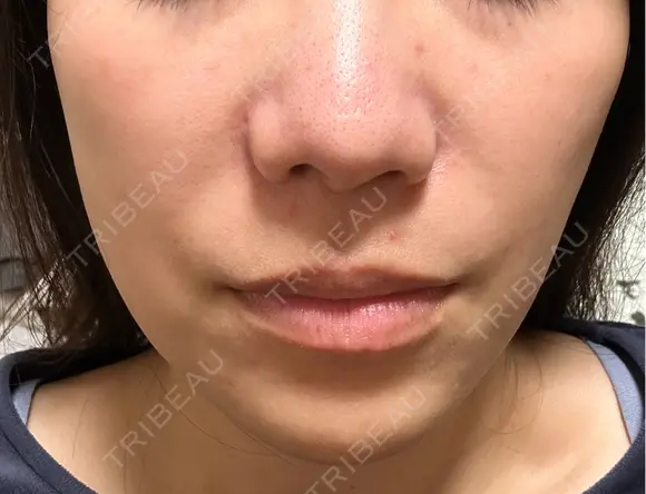 ヒアルロン酸注入（鼻翼基部） KIMI CLINIC 形成・美容外科 AFTER メイン用