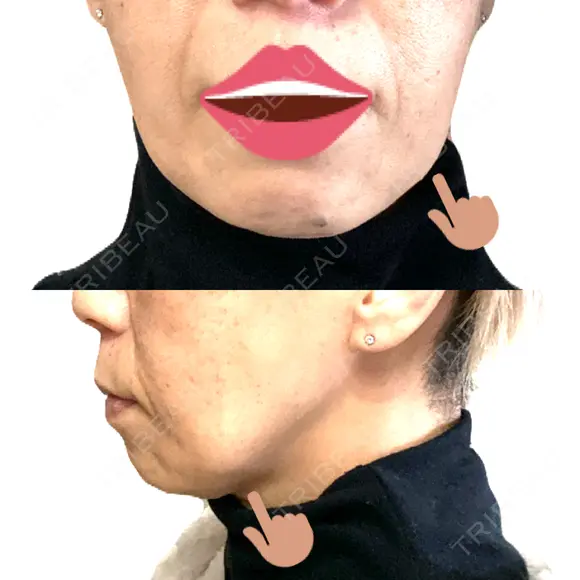 ボトックス（エラ・小顔） / ヒアルロン酸注入（頬） 新未来クリニック AFTER メイン用