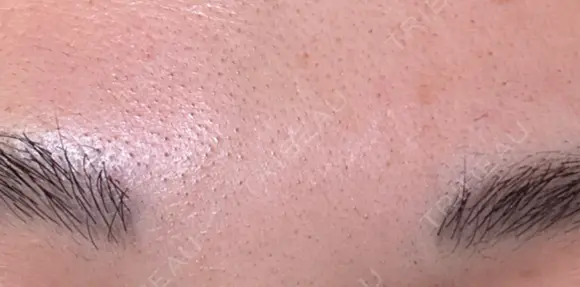 ボトックス（眉間） Leap beauty clinic DAY 4 メイン用