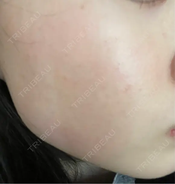 レーザートーニング（美白・肝斑） セカジソウォン医院-明洞店 AFTER メイン用