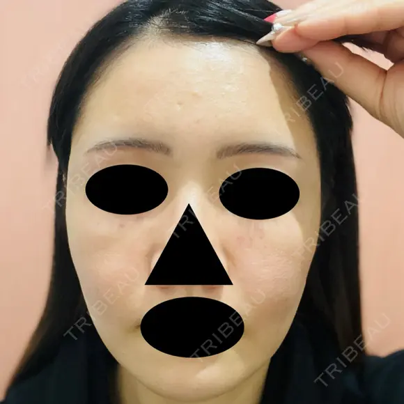 ヒアルロン酸注入（頬） / ヒアルロン酸注入（こめかみ） 仙台N美容クリニック DAY 0 メイン用