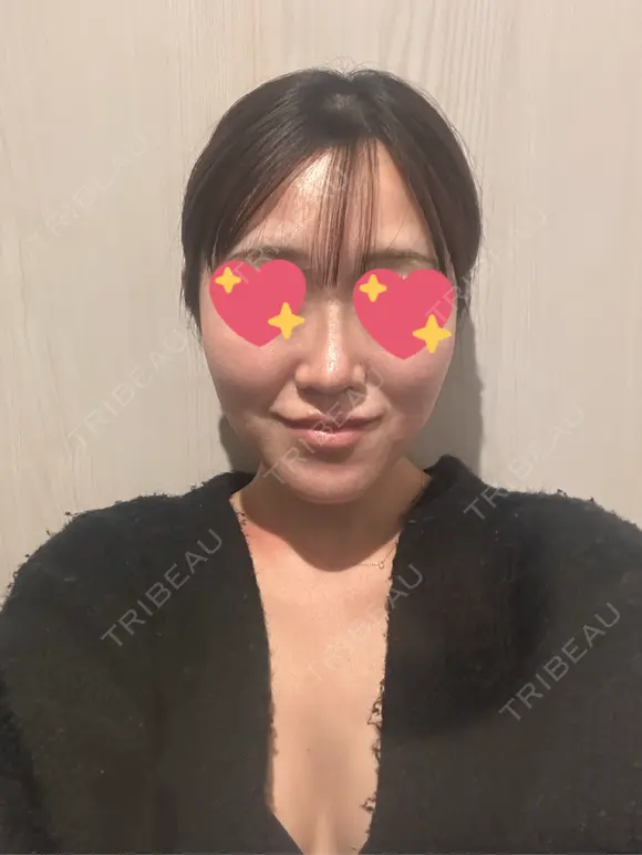 隆鼻術 / 鼻尖形成（切開） / 鼻中隔延長（切開） / 軟骨移植 / 斜鼻修正 / 鼻孔縁挙上 / 鼻翼基部形成（貴族手術） / 鼻柱下降・鼻唇角形成（猫手術） 4Dクリニック DAY 36 メイン用