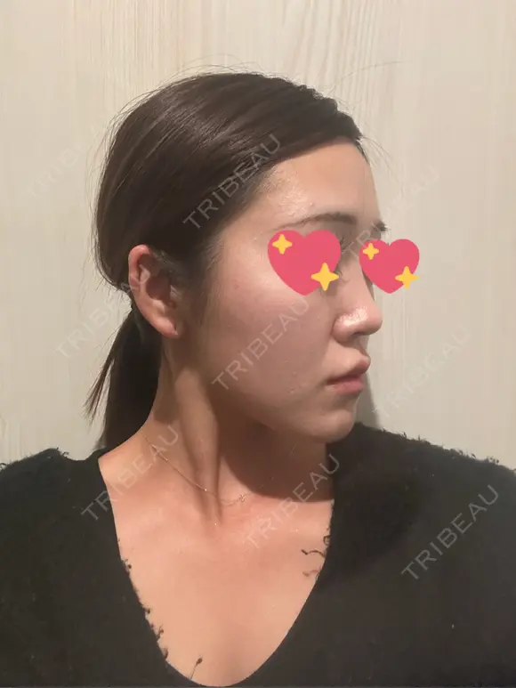 隆鼻術 / 鼻尖形成（切開） / 鼻中隔延長（切開） / 軟骨移植 / 斜鼻修正 / 鼻孔縁挙上 / 鼻翼基部形成（貴族手術） / 鼻柱下降・鼻唇角形成（猫手術） 4Dクリニック DAY 43 メイン用