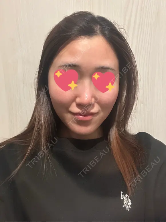 隆鼻術 / 鼻尖形成（切開） / 鼻中隔延長（切開） / 軟骨移植 / 斜鼻修正 / 鼻孔縁挙上 / 鼻翼基部形成（貴族手術） / 鼻柱下降・鼻唇角形成（猫手術） 4Dクリニック DAY 45 メイン用