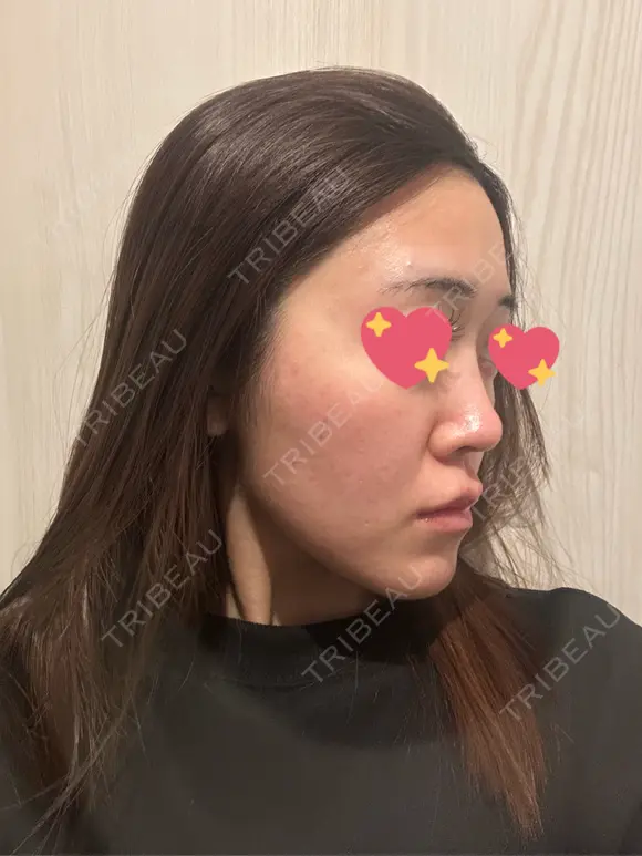隆鼻術 / 鼻尖形成（切開） / 鼻中隔延長（切開） / 軟骨移植 / 斜鼻修正 / 鼻孔縁挙上 / 鼻翼基部形成（貴族手術） / 鼻柱下降・鼻唇角形成（猫手術） 4Dクリニック DAY 45 メイン用