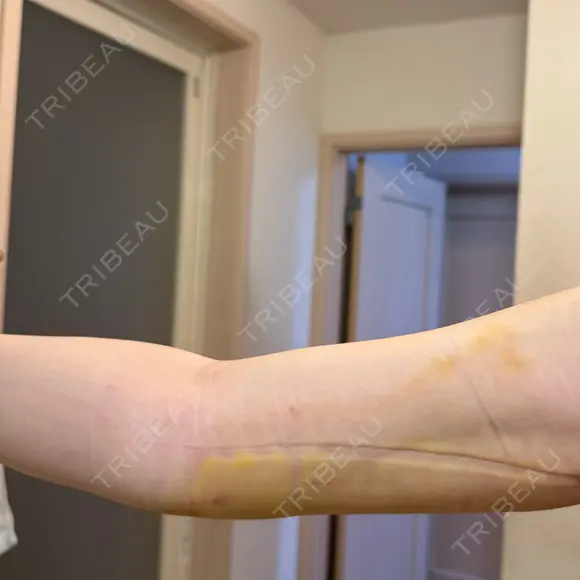 脂肪吸引（顔） / 脂肪吸引（二の腕） / 脂肪吸引（脚） / 脂肪吸引（お腹） / 脂肪吸引（お尻） / 脂肪吸引（腰） / 脂肪吸引（背中） / 脂肪吸引（肩） ヴェルトラクリニック 新宿院 DAY 9 メイン用