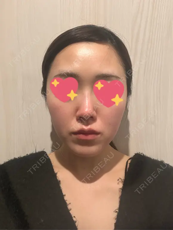 隆鼻術 / 鼻尖形成（切開） / 鼻中隔延長（切開） / 軟骨移植 / 斜鼻修正 / 鼻孔縁挙上 / 鼻翼基部形成（貴族手術） / 鼻柱下降・鼻唇角形成（猫手術） 4Dクリニック AFTER メイン用