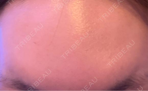 ボトックス（眉間） / ボトックス（額） TCB東京中央美容外科 八王子院 DAY 21 メイン用