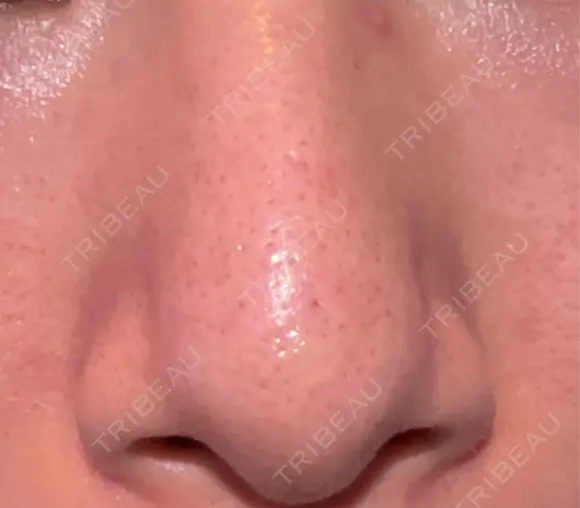 アグネス 日本美容・医療クリニック 六本木院 DAY 24 メイン用