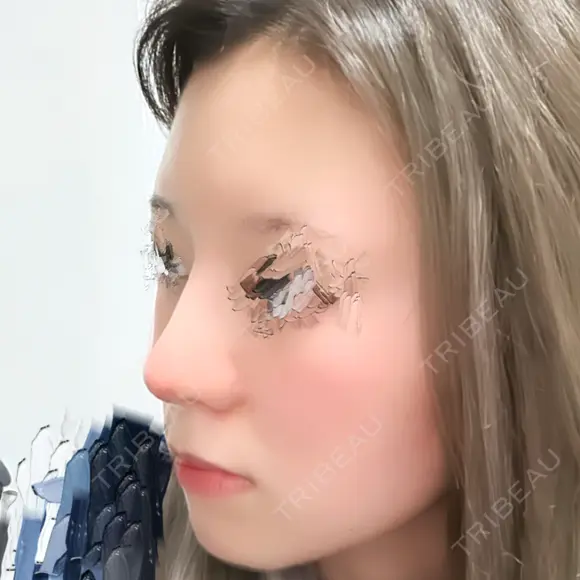 鼻尖形成（切開） / 鼻中隔延長（切開） / 軟骨移植 / 鼻修正 4Dクリニック DAY 17 メイン用
