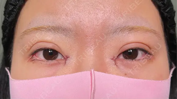 二重埋没 / 目頭切開 HAAB×DREAM BEAUTY CLINIC 大阪梅田院 DAY 0 メイン用