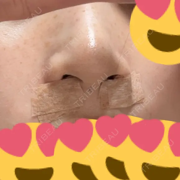 小鼻縮小（切開） アネシス美容クリニック DAY 0 メイン用