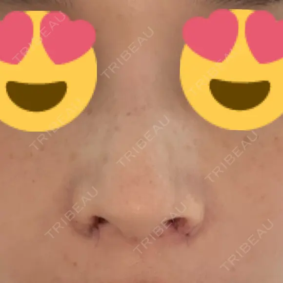 小鼻縮小（切開） アネシス美容クリニック DAY 1 メイン用