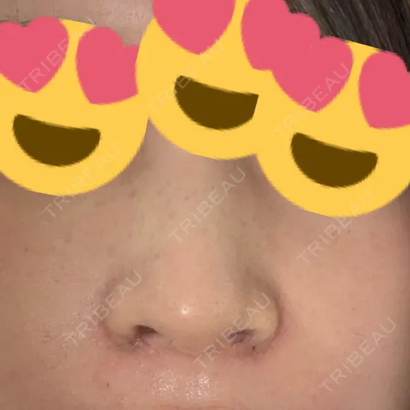 小鼻縮小（切開） アネシス美容クリニック DAY 6 メイン用