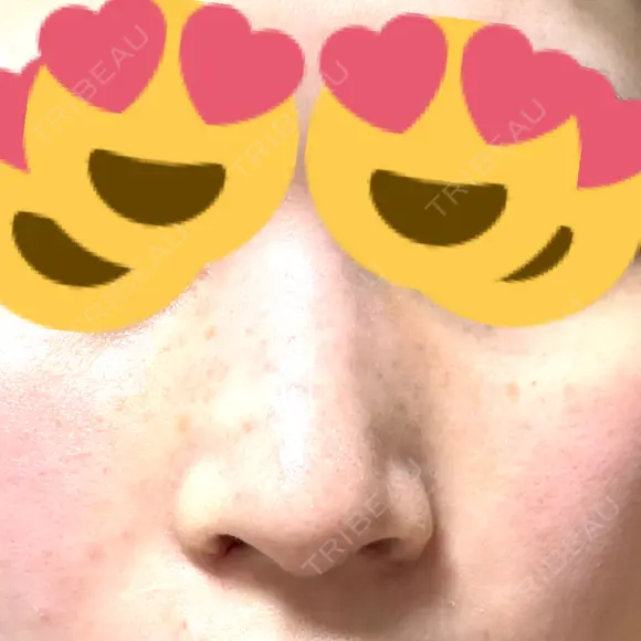 小鼻縮小（切開） アネシス美容クリニック DAY 7 メイン用