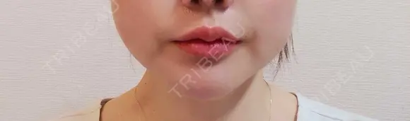 ヒアルロン酸注入（涙袋） / ヒアルロン酸注入（唇） 共立美容外科 梅田院 DAY 1 メイン用