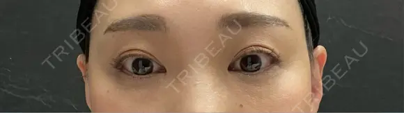 眉下切開 / ボトックス（眉間） / ボトックス（目尻） PRO CLINIC プロクリニック 銀座院 DAY 69 メイン用