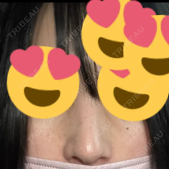 小鼻縮小（切開） アネシス美容クリニック DAY 11 メイン用