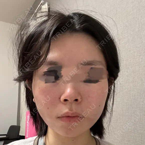 糸リフト / 脂肪吸引（顔） / ジョールファット除去 A CLINIC（エークリニック） 横浜院 DAY 0 メイン用