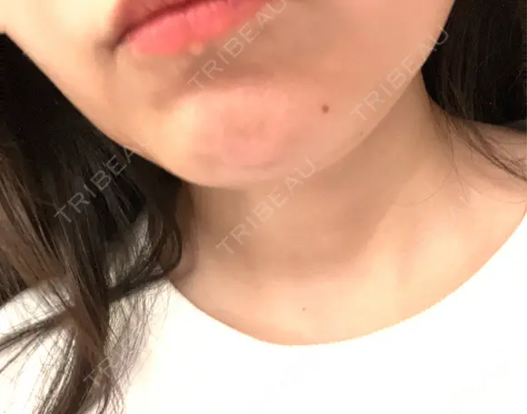ボトックス（あご） / ボトックス（エラ・小顔） / ボトックス（眉間） TCB東京中央美容外科 枚方院 DAY 0 メイン用